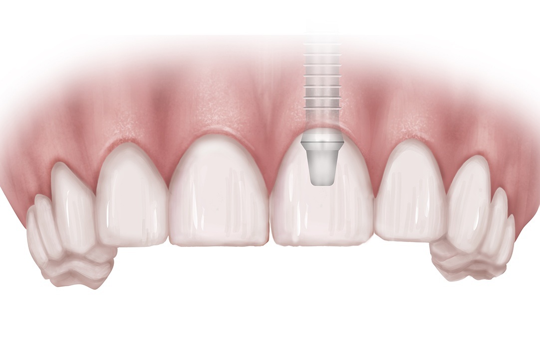 Can dental implants cause allergic reactions?