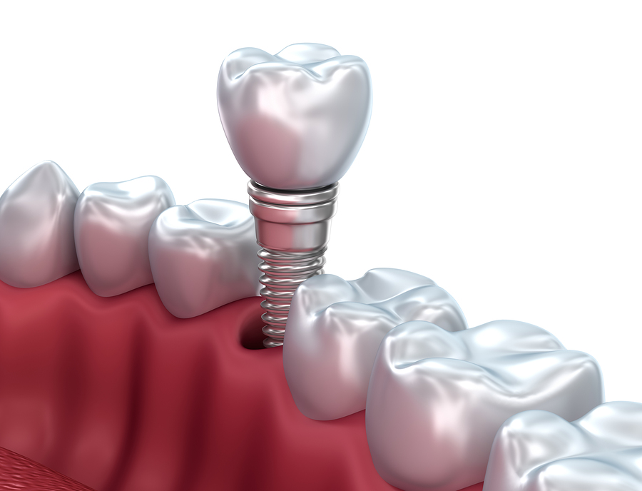 Can Dental Implants Cause Allergic Reactions, Implantinduced Allergy, Dental Implant Allergies, Allergic Responses to Dental Implants, Dental Implant Sensitivities, Hypersensitivity to Dental Implants, Implantrelated Allergic Reactions, Allergenicity of Dental Implants, Dental Implant Hypersensitivity, Allergy Potential of Dental Implants, Reactions to Dental Implant Materials, Allergies and Dental Implants, Dental Implant Allergic Manifestations, Allergic Reactions to Implant Treatment, Can Dental Implants Trigger Allergies, Dental Implant Complications and Allergic Reactions, Dental Implant Sensitivity Risks, Allergic Response to Dental Restoration, Dental Implant Materials and Allergies, Allergic Reactions in Dental Implant Patients, Dental Implants and Allergic Symptoms, Allergic Reactions to Tooth Implants, Allergy Risks with Dental Implant Surgery, Allergies and Sensitivities in Dental Implant Cases, Allergic Reactions to Oral Implants